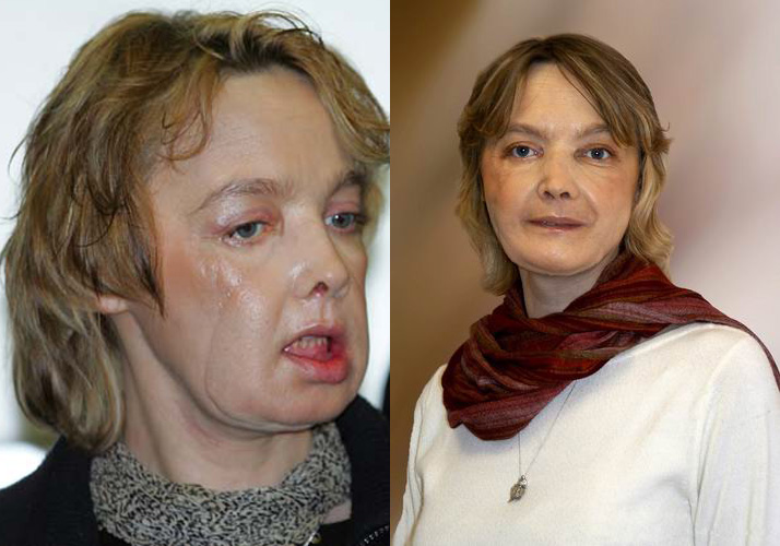 In profondità pulizia di un tempo su una faccia