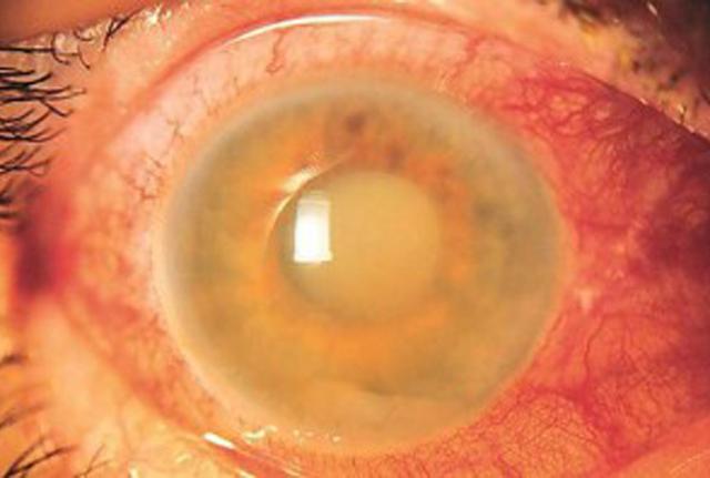 Glaucoma, nuova cura: un collirio creato col cordone ombelicale