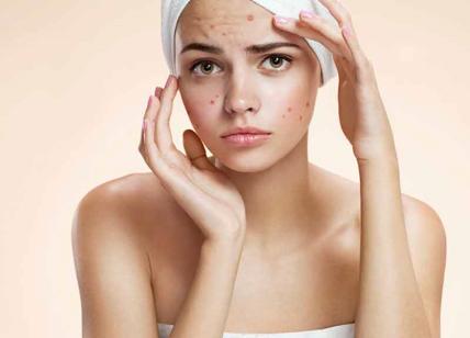 Avete sofferto di acne da giovani? Da “grandi” non avrete le rughe