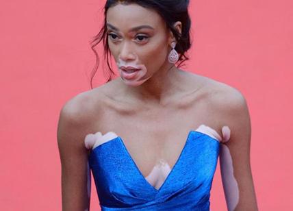 Winnie Harlow a Cannes: chi è la modella con la vitiligine Winnie Harlow a Cannes: chi è la modella con la vitiligine
