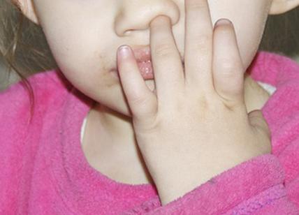Dita nel naso, allarme: con le dita nel naso si rischia una polmonite mortale