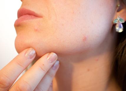 Inestetismi della pelle del viso: ne soffrono oltre 3,5 mln italiani