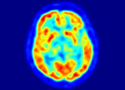 Alzheimer molecola ringiovanisce cervello e blocca malattia ALZHEIMER NEWS