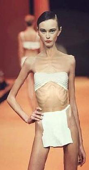 anoressia femminile anoressia femminile