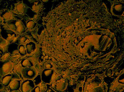 Cellulare tumore interna Cellule tumore