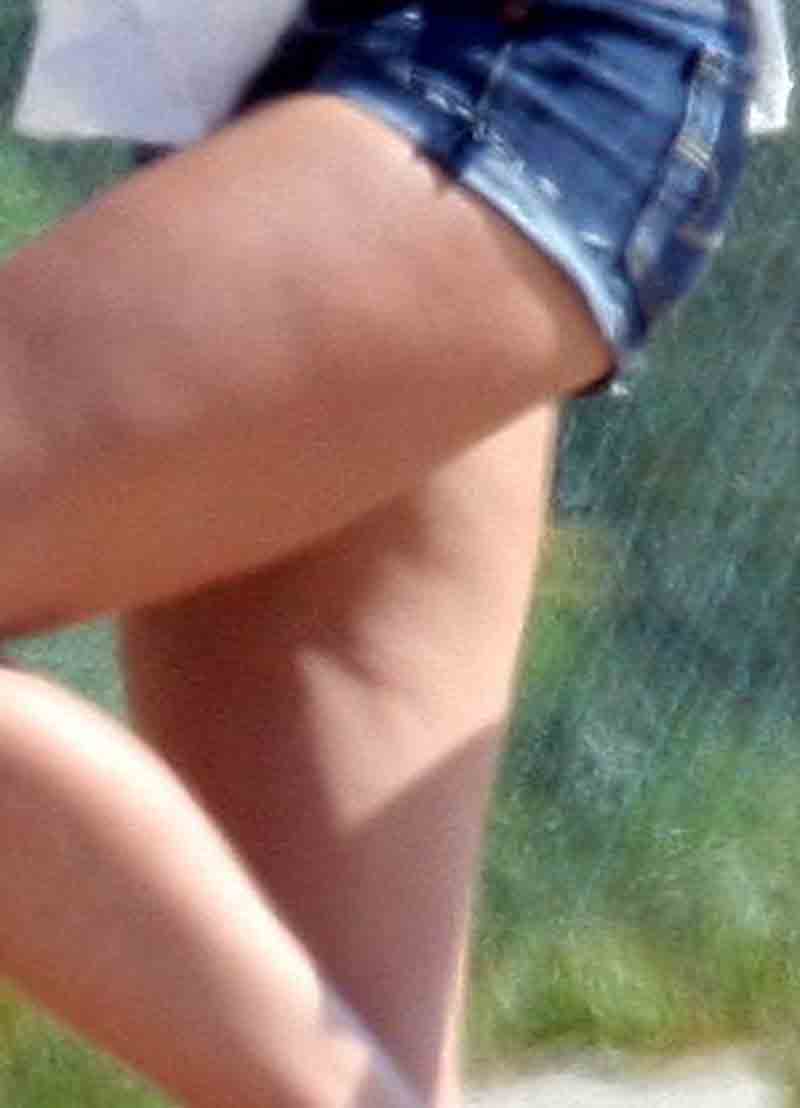 cellulite (3)