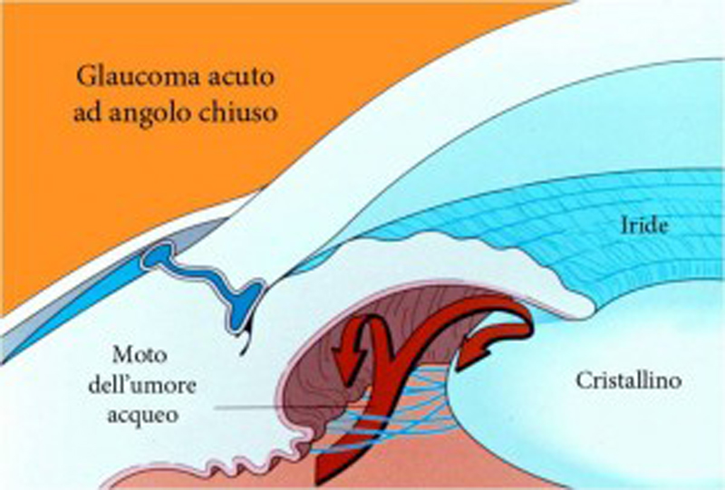 glaucoma (1) glaucoma (1)