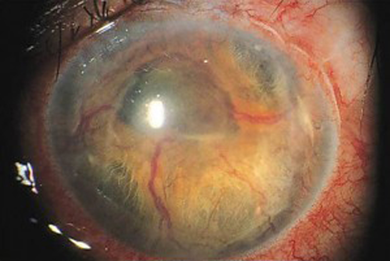 glaucoma (5) glaucoma (5)