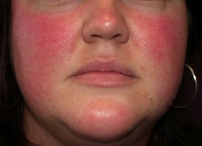 rosacea4