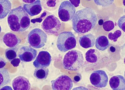Mieloma multiplo, un tumore raro: al via il più ampio studio globale