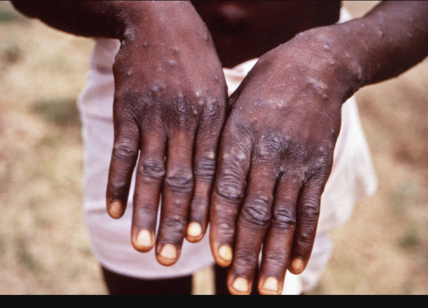 Monkeypox, il vaiolo delle scimmie spaventa il mondo: la cura non c'è