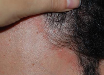 Mascherine per il Covid-19: come evitare che la dermatite seborroica s'aggravi