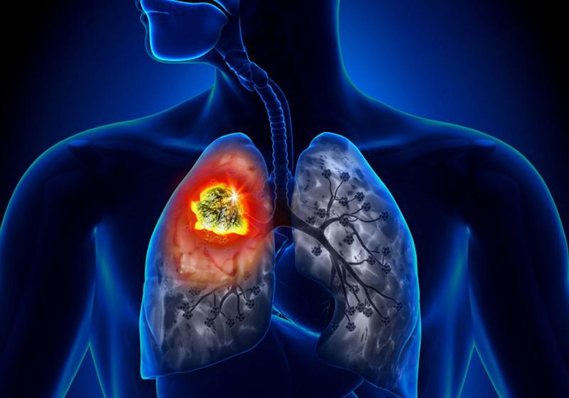 tumore al polmone 2 1000x700