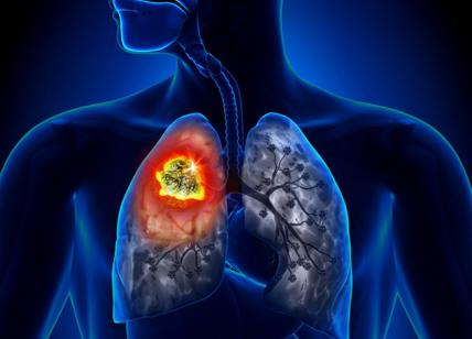 Tumore ai polmoni, ogni anno in Italia fino a 6mila casi di microcitoma