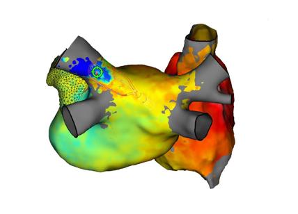 Cuore in 3D: nuova mappatura dell’attività cardiaca per colpire l'aritmia