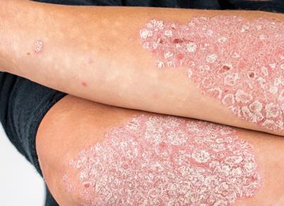 Immagine psoriasi