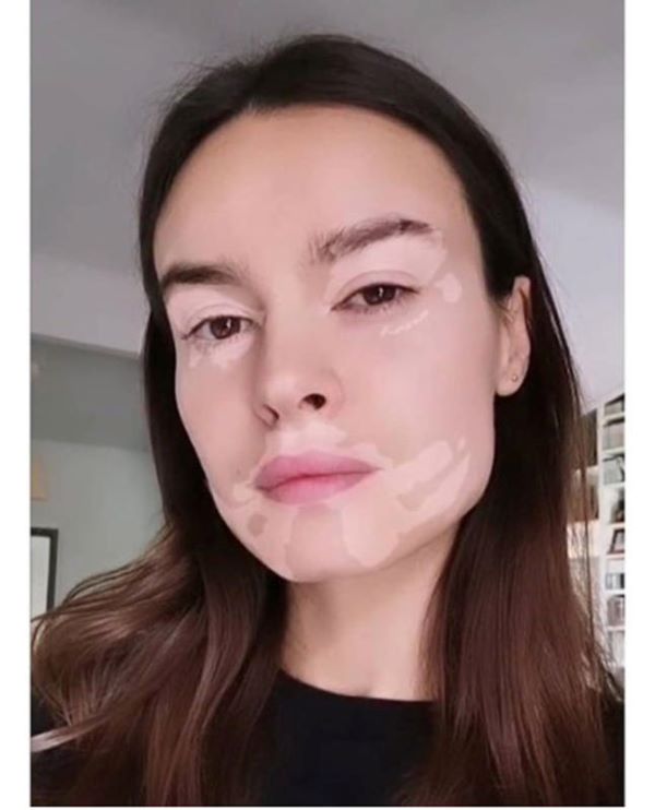 Kasia Smutniak in una foto col filtro pro vitiligine da lei creato Kasia Smutniak in una foto col filtro pro vitiligine da lei creato