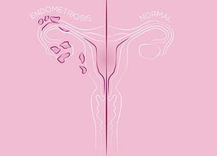 Endometriosi: perché le donne aspettano 8 anni per una diagnosi?