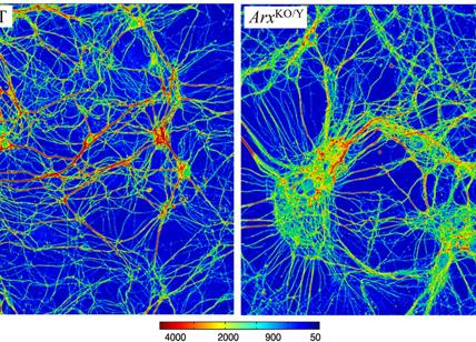 Malattie neurologiche: identificati i difetti genetici di due patologie gravi