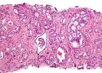 Tumore della prostata: studio Arasens, buoni risultati per darolutamide