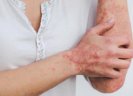 Psoriasi: le nuove terapie partono dai farmaci biologici