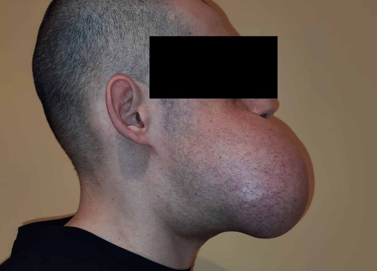 Gli ricostruiscono la mandibola affetta da tumore con il suo stesso perone Gli ricostruiscono la mandibola affetta da tumore con il suo stesso perone