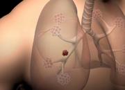 Tumore ai polmoni, c'è la svolta: un farmaco capace di fermare la malattia