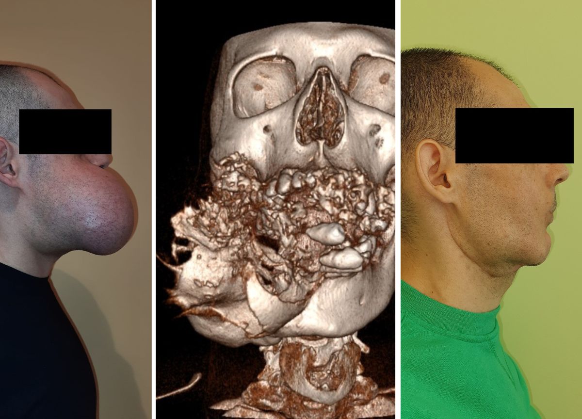 Gli ricostruiscono la mandibola affetta da tumore con il suo stesso perone Gli ricostruiscono la mandibola affetta da tumore con il suo stesso perone