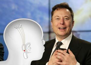 Neuralink fa la storia: il chip di Musk riaccende i movimenti di un veterano paralizzato