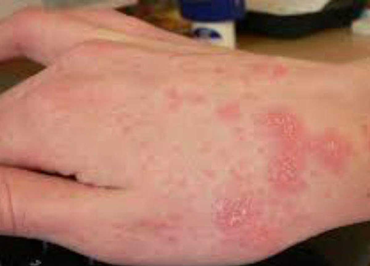 scabbia scabbia