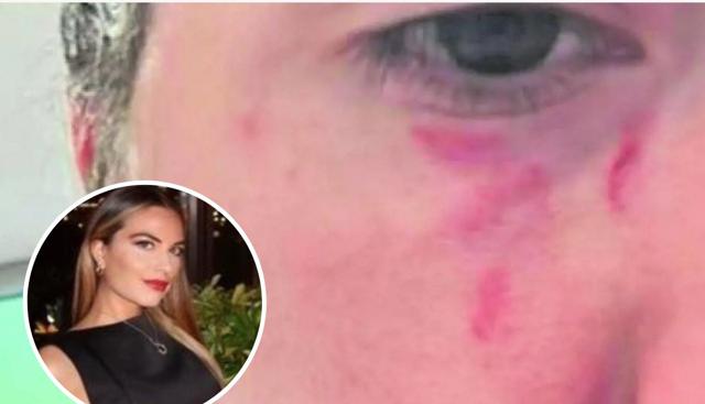 I lividi sul volto di Pamela Genini (fonte: Mattino 5) I lividi sul volto di Pamela Genini (fonte: Mattino 5)