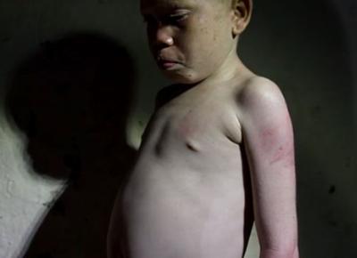 Bimbo albino di un anno barbaramente mutilato in Tanzania