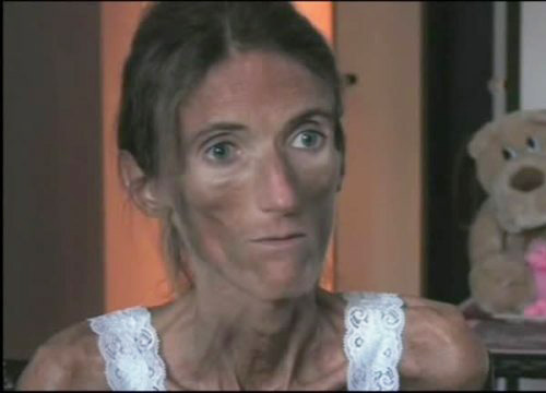 video anoressia mediaset video anoressia mediaset