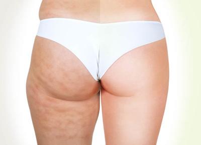 RADIOSOUND: ADDIO CELLULITE IN UNA SOLA SEDUTA!