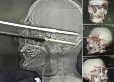 Sopravvive dopo essersi sparato in testa un arpione