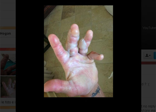 Esplode il termosifone: Hulk Hogan finisce all’ospedale Esplode il termosifone: Hulk Hogan finisce all’ospedale