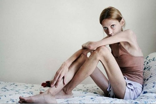 “Niente cure, Dio mi curerà”. Muore 19enne anoressica “Niente cure, Dio mi curerà”. Muore 19enne anoressica