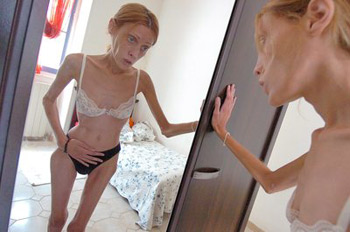 “Niente cure, Dio mi curerà”. Muore 19enne anoressica “Niente cure, Dio mi curerà”. Muore 19enne anoressica