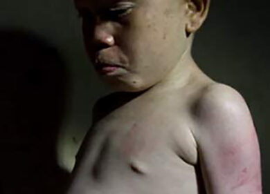 Da Africa bianca a White shadow, così l’albinismo esce dall’oscurità