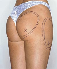 Chirurgia estetica per un sedere da sogno: amputate gambe e braccia a una donna