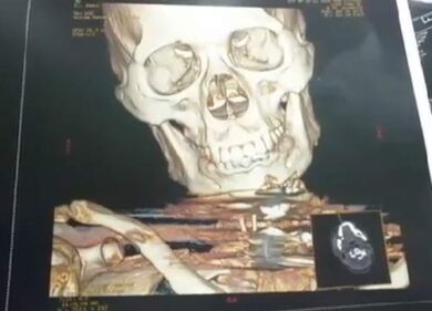 Sette barre di metallo nel collo. Imprenditore vivo per miracolo