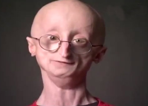 È morto Sam, il bimbo che invecchiava troppo in fretta È morto Sam, il bimbo che invecchiava troppo in fretta
