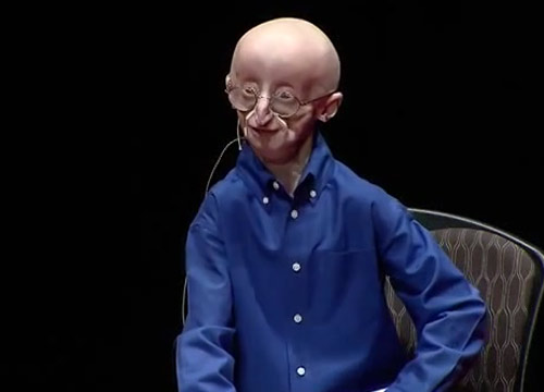 È morto Sam, il bimbo che invecchiava troppo in fretta È morto Sam, il bimbo che invecchiava troppo in fretta