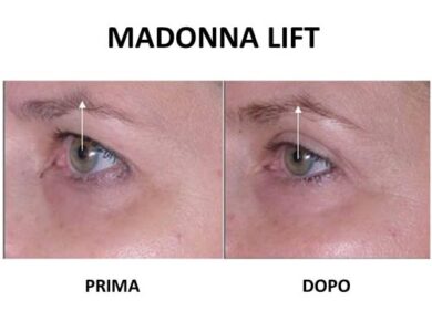Madonna lift, l’alternativa vincente alla blefaroplastica