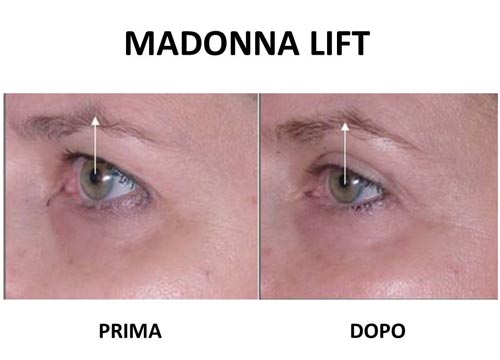 Madonna Lift (1) Madonna Lift (1)