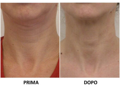 Ridare tono alla pelle del viso senza chirurgia: new golden lift