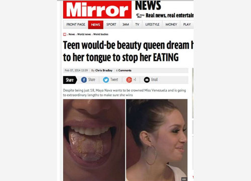 Si cuce la lingua per non mangiare. “Così dimagrisco e divento miss” Si cuce la lingua per non mangiare. “Così dimagrisco e divento miss”