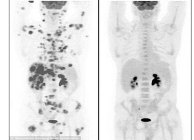 Ha 70 tumori letali in tutto il corpo, ma si salva miracolosamente