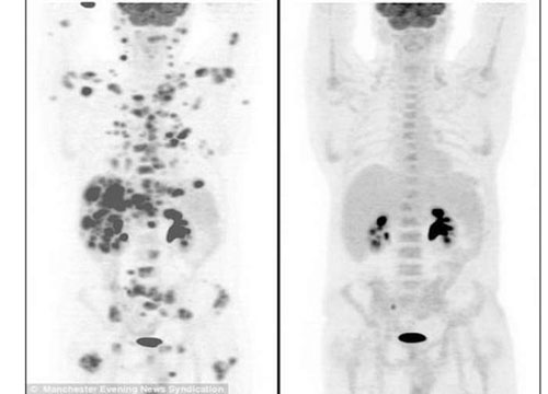 Ha 70 tumori letali in tutto il corpo, ma si salva miracolosamente Ha 70 tumori letali in tutto il corpo, ma si salva miracolosamente