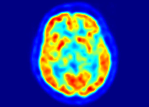 Morbo di Alzheimer, nuova scoperta. La predisposizione è genetica Morbo di Alzheimer, nuova scoperta. La predisposizione è genetica